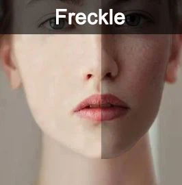 freckle freckle