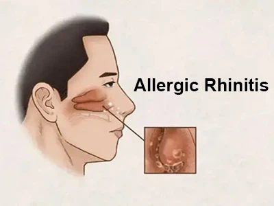 Laurocapram azone for allergic rhinitis Laurocapram azone for allergic rhinitis